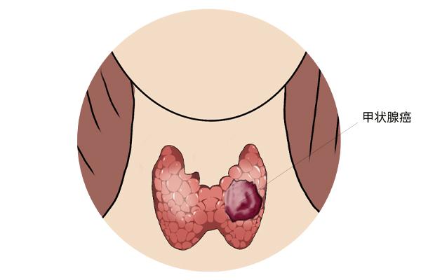 甲狀腺癌癥的主要癥狀表現(xiàn)有什么？為什么會(huì)得甲狀腺癌癥呢？