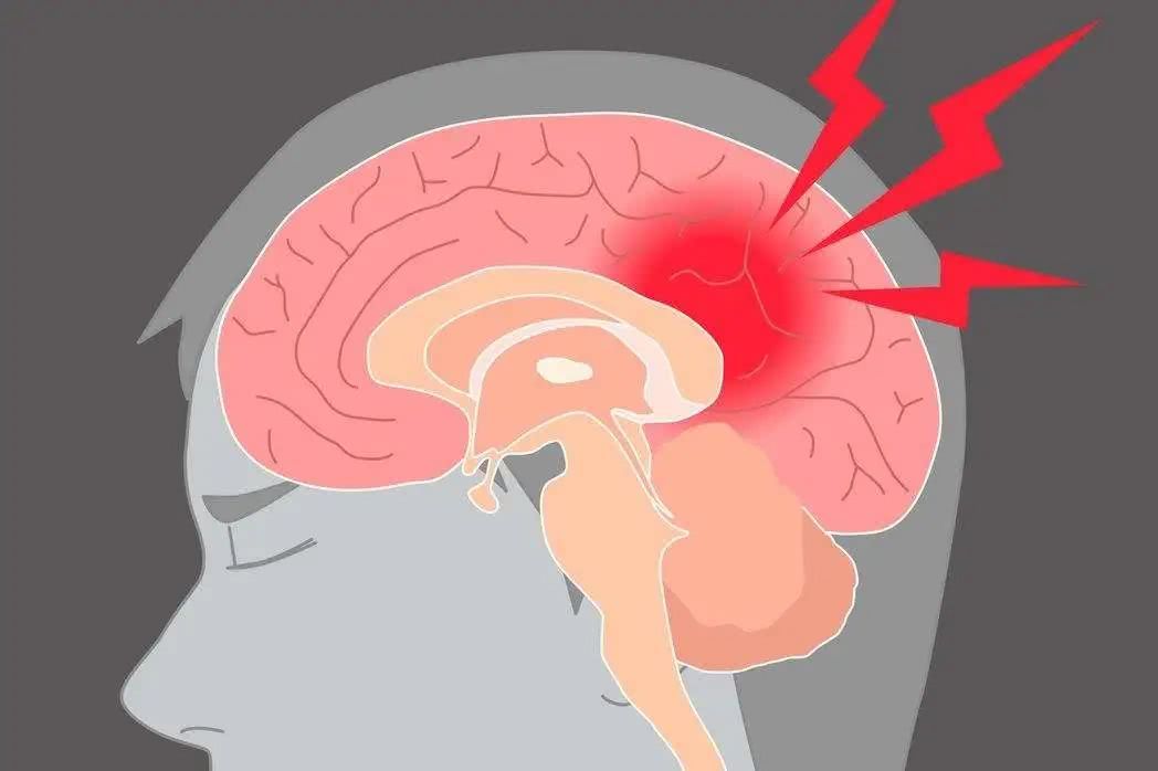 預(yù)防腦梗從習(xí)慣做起，這三大壞習(xí)慣，有的趕緊改正！